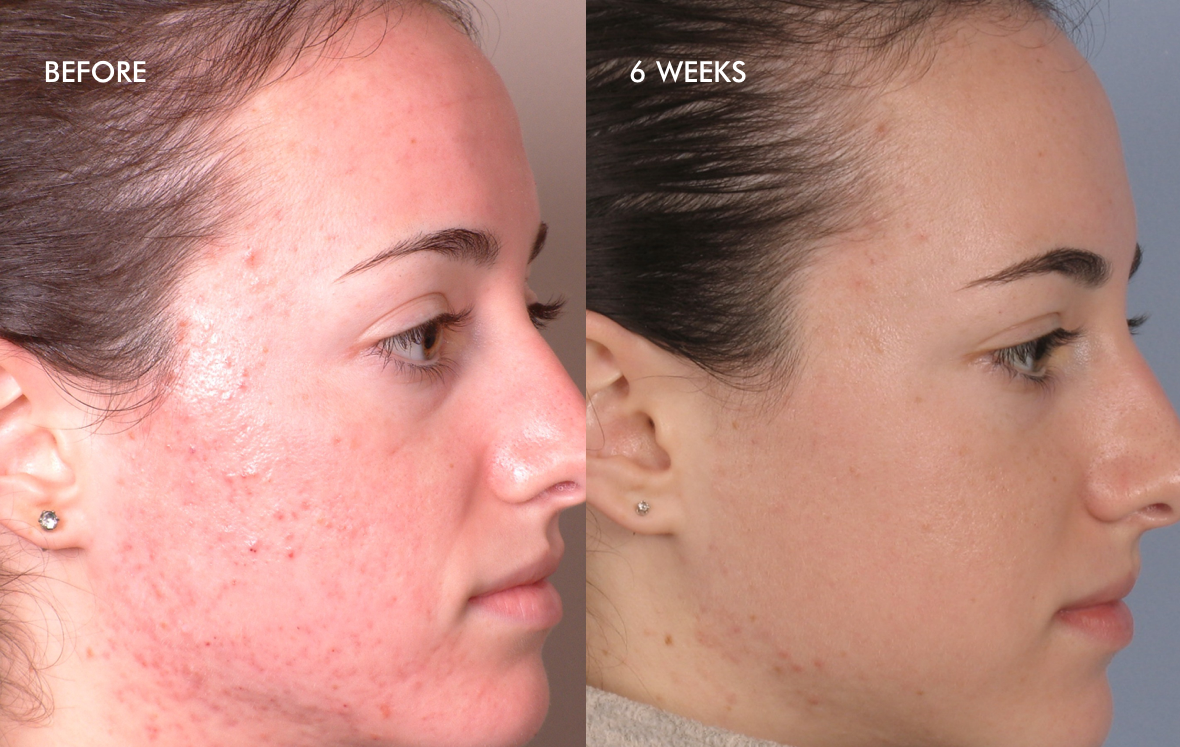 before-after-acne-two (1)