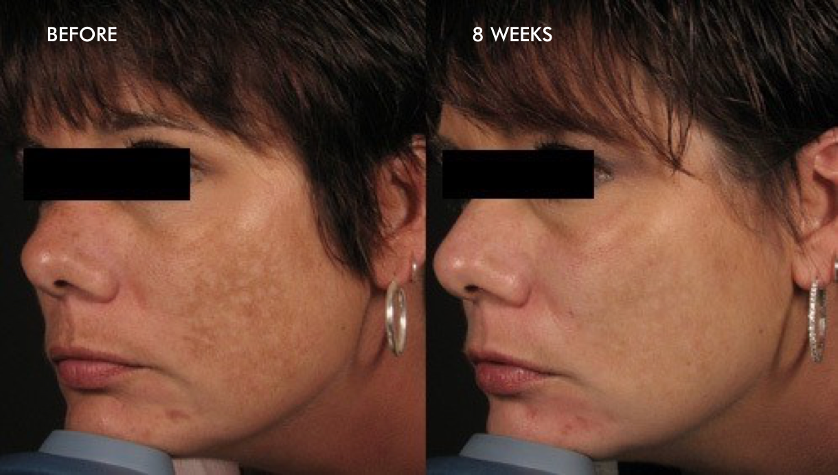 before-after-melasma