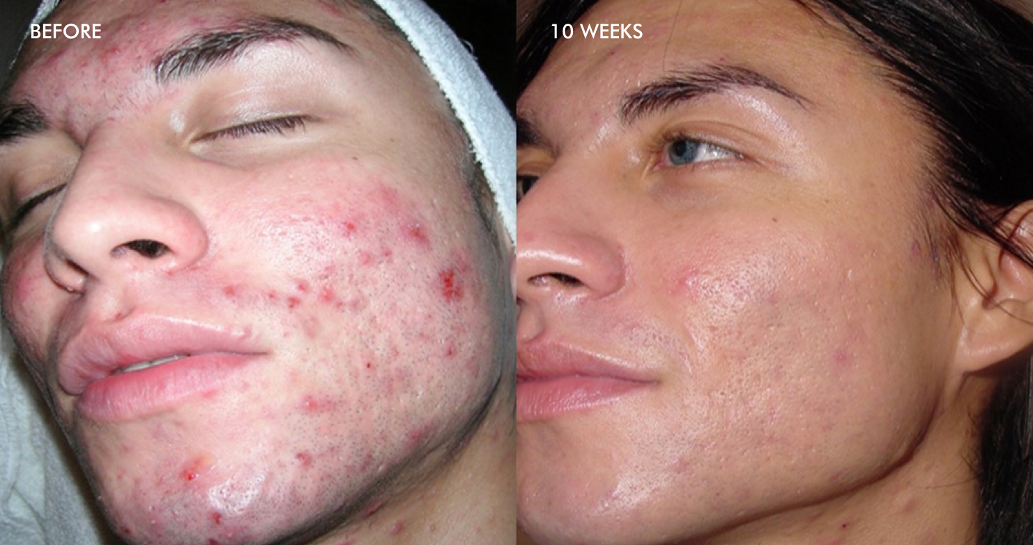 before after acne