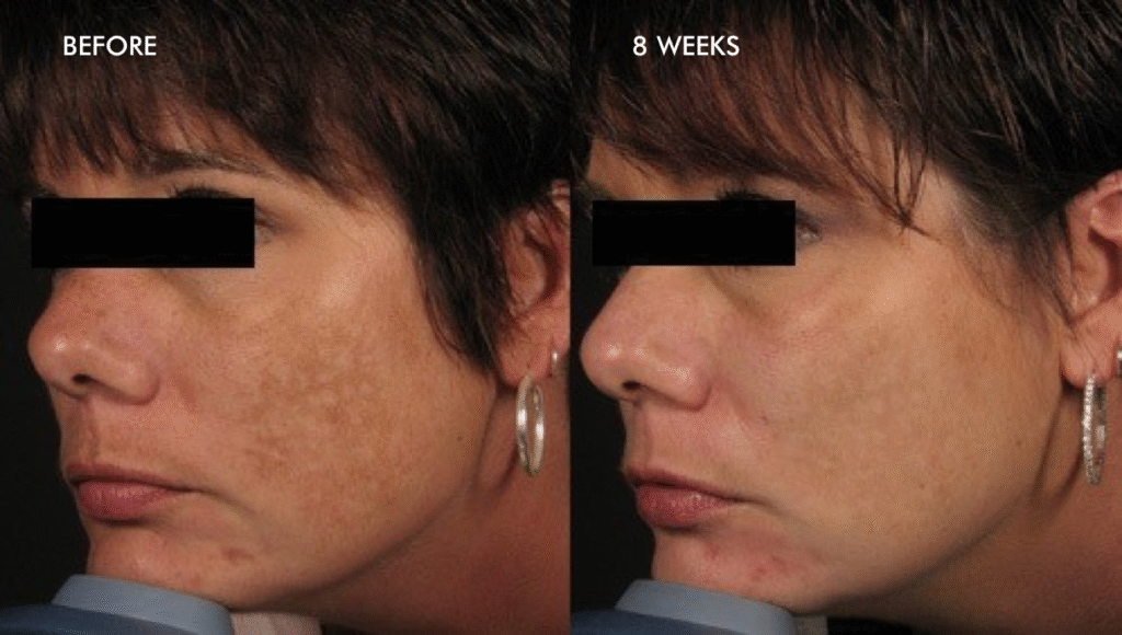 before after melasma